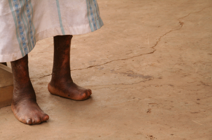 photo of a leper's damaged feet
